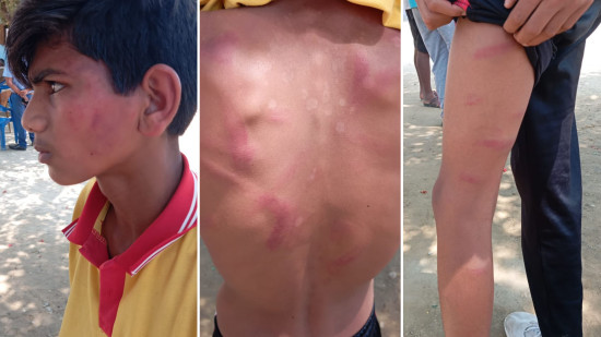 सिरहामा शिक्षकको कुटाइबाट १३ वर्षीय बालक अस्पताल भर्ना 