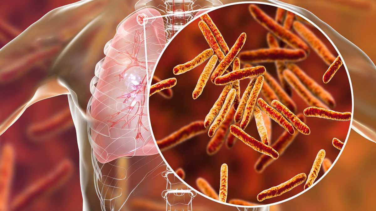 कोशी प्रदेशका तीन जिल्लामा क्षयरोगका बिरामी बढी